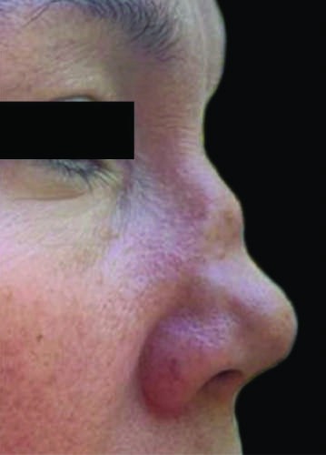 (Continued) *— Figure 378-2B: Saddle nose deformity in relapsing polychondritis
