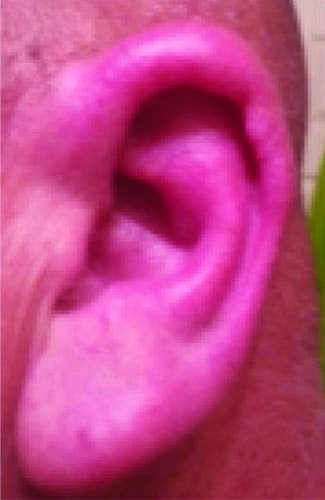Representation of ear involvement in relapsing polychondritis