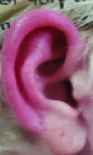 Representation of ear involvement in relapsing polychondritis