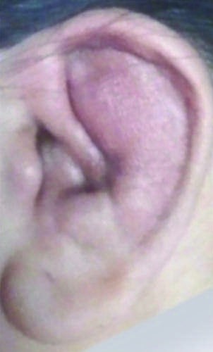 (Continued) *— Figure 378-1 (Continued): Additional views of ear involvement...