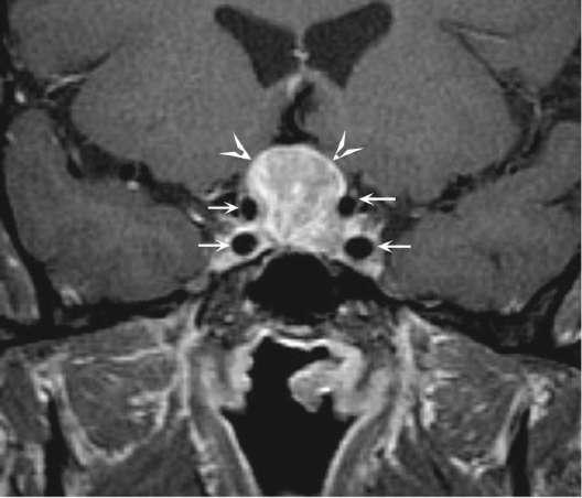 Expanding pituitary mass