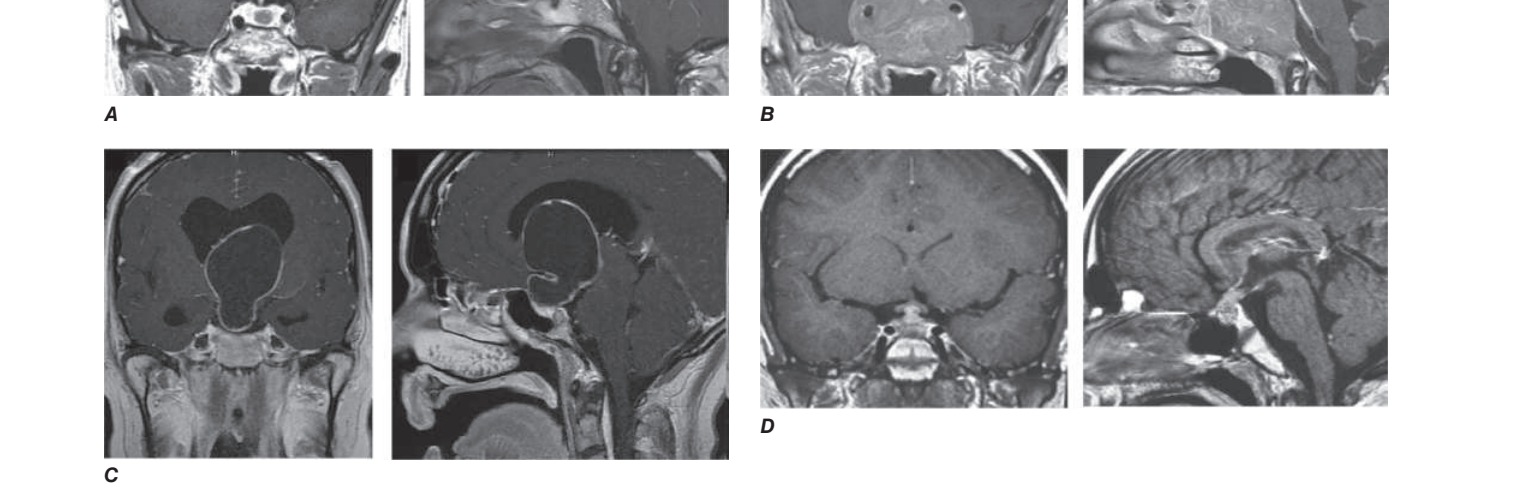 Imaging differential diagnosis of sellar masses
