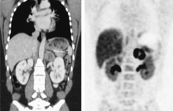 Typical pheochromocytoma (adrenal unilateral)