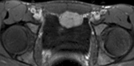 Typical pheochromocytoma (adrenal unilateral)