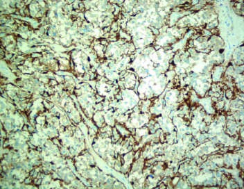 Multiple and metastatic pheochromocytoma
