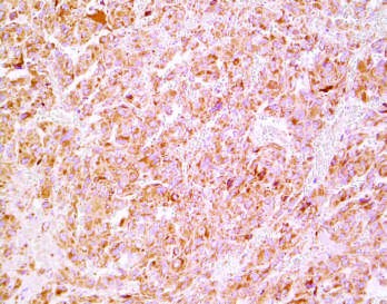 Multiple and metastatic pheochromocytoma