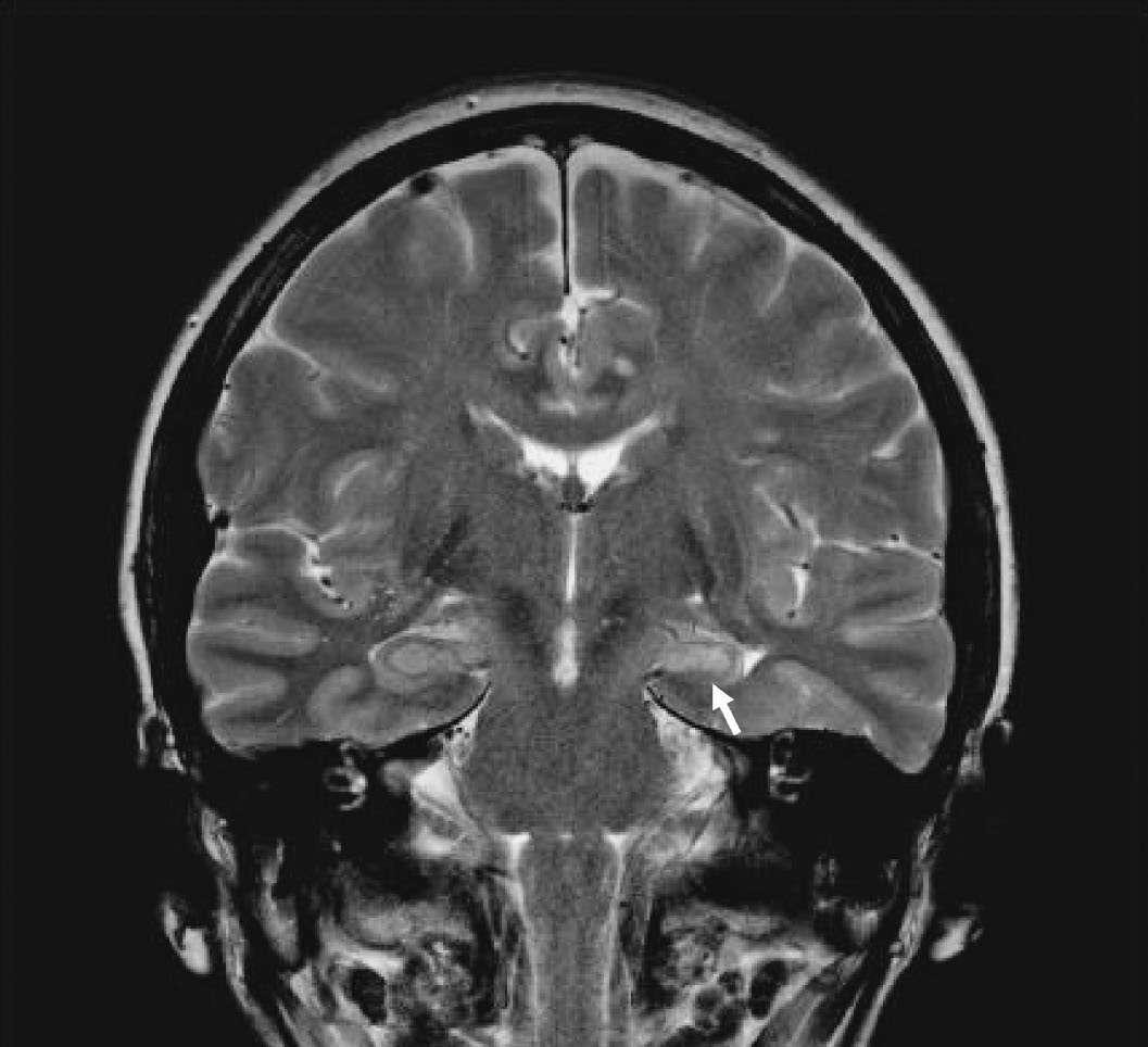Mesial temporal lobe epilepsy