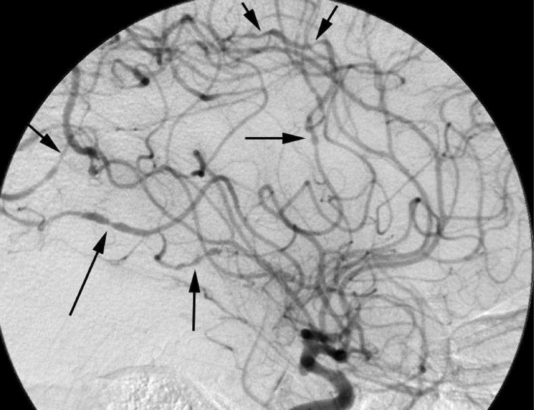 Ischemic Stroke 438 FIGURE 438-6 Cerebral angiogram from a 32-year-old...