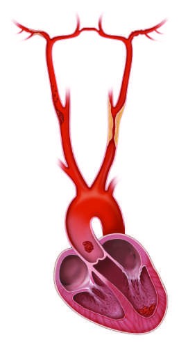 Pathophysiology of ischemic stroke