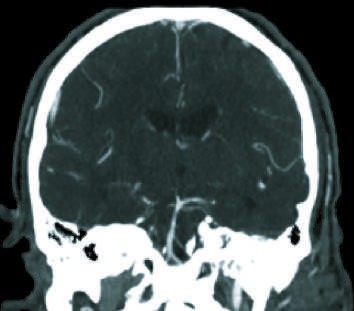 Diagrams and reformatted computed tomography (CT) angiograms in the the...