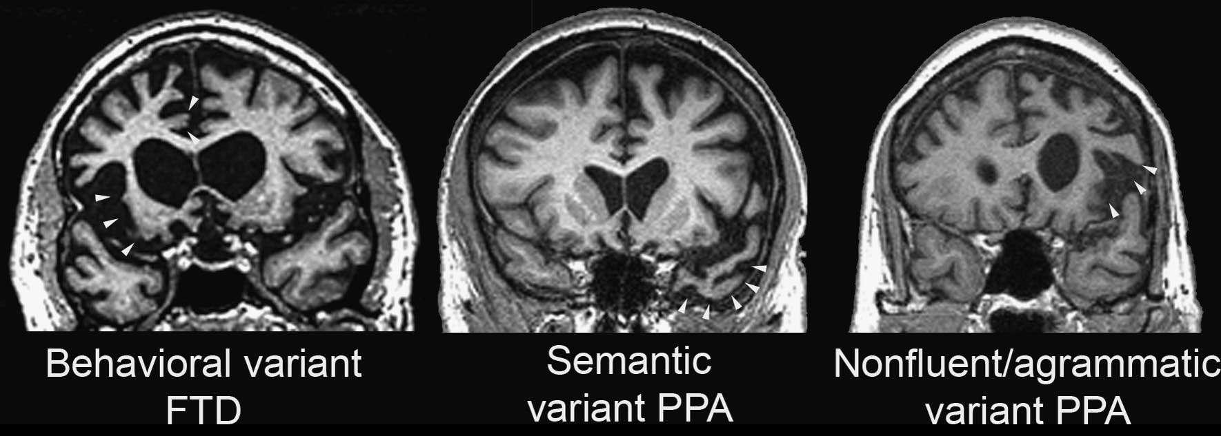 Three major frontotemporal dementia (FTD) clinical syndromes