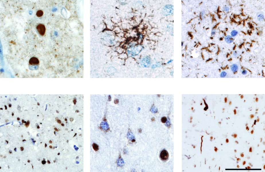 Neuropathology in frontotemporal lobar degeneration (FTLD)