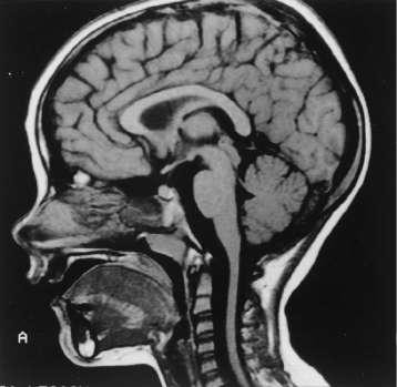 Sagittal magnetic resonance imaging (MRI) of the brain and spinal...