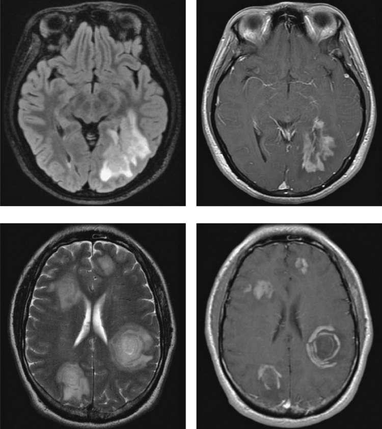 Magnetic resonance imaging findings in variants of MS