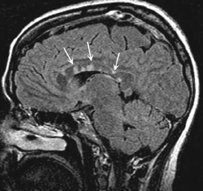 Magnetic resonance imaging findings in multiple sclerosis (MS)