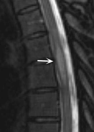 Magnetic resonance imaging findings in multiple sclerosis (MS)