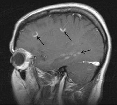 Magnetic resonance imaging findings in multiple sclerosis (MS)