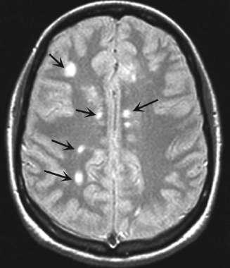 Magnetic resonance imaging findings in multiple sclerosis (MS)