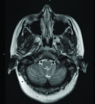 Imaging findings in neuromyelitis optica: longitudinally extensive inversion recovery (FLAIR)...