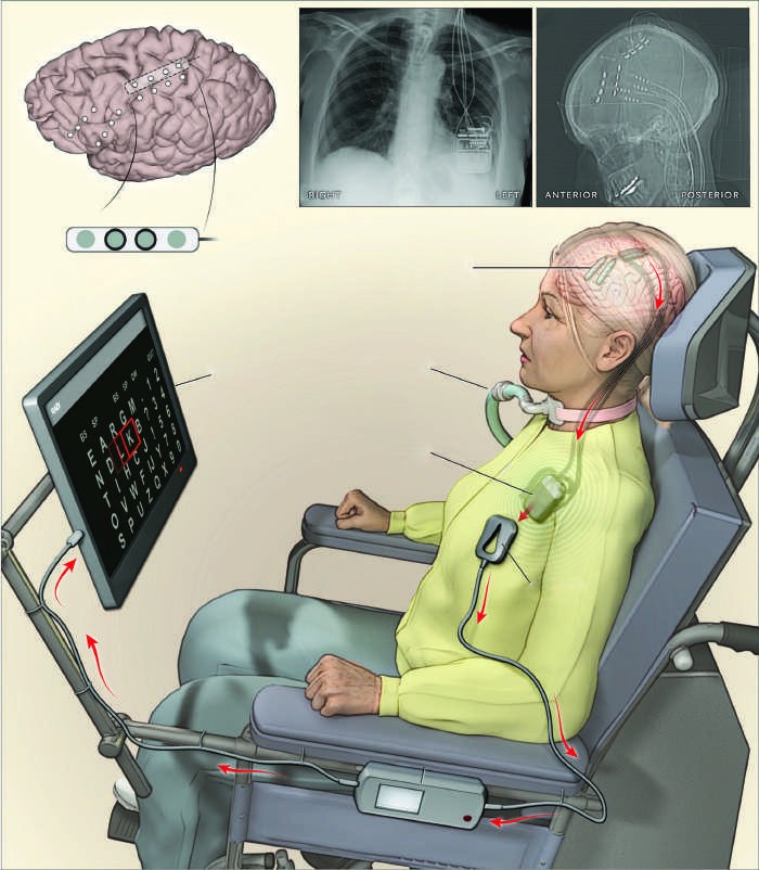 Illustration of an amyotrophic lateral sclerosis (ALS) patient with a...
