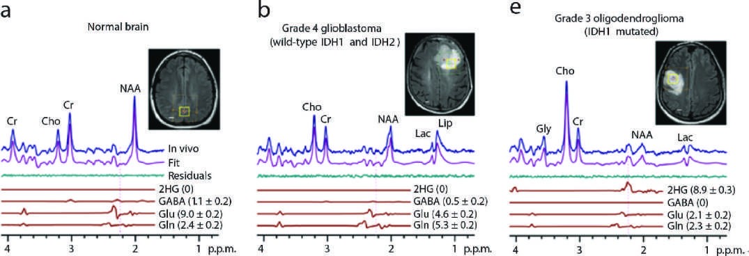 In vivo 1H spectra and analysis demonstrating 2-hydroxyglutarate (2-HG) spectra...